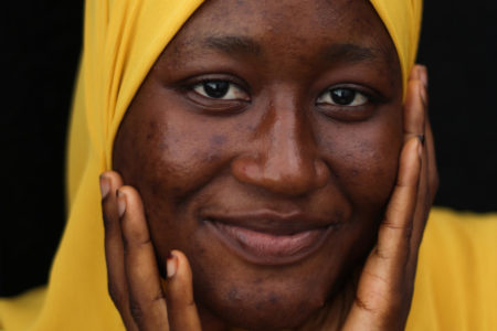 Aisha Ife's Skin Series is Giving Visibility to People Living with Acne